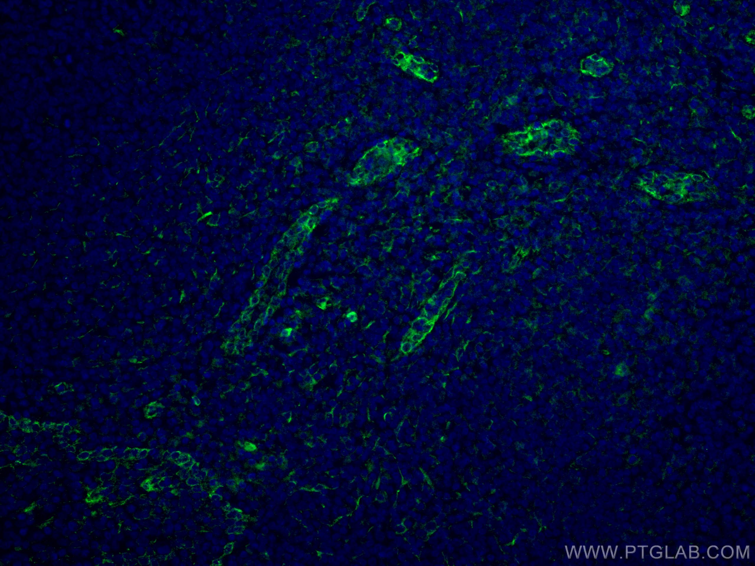 IF Staining of human tonsillitis using 67128-1-Ig