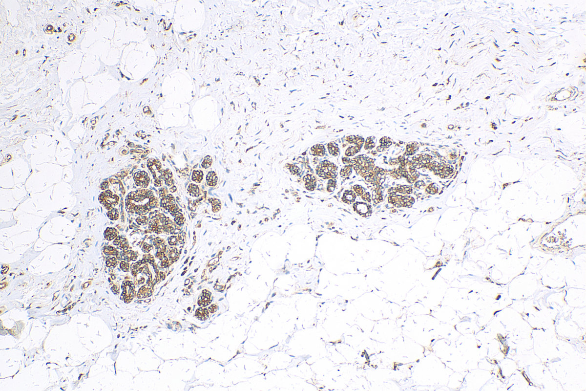 IHC staining of human breast cancer using 14996-1-AP