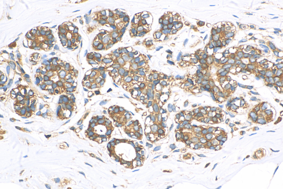 IHC staining of human breast cancer using 14996-1-AP