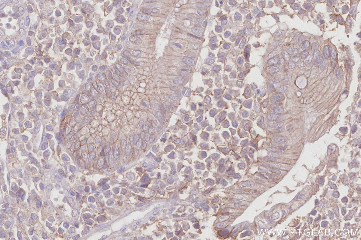 IHC staining of human appendicitis using 67228-1-Ig IHC staining of human appendicitis using 67228-1-Ig