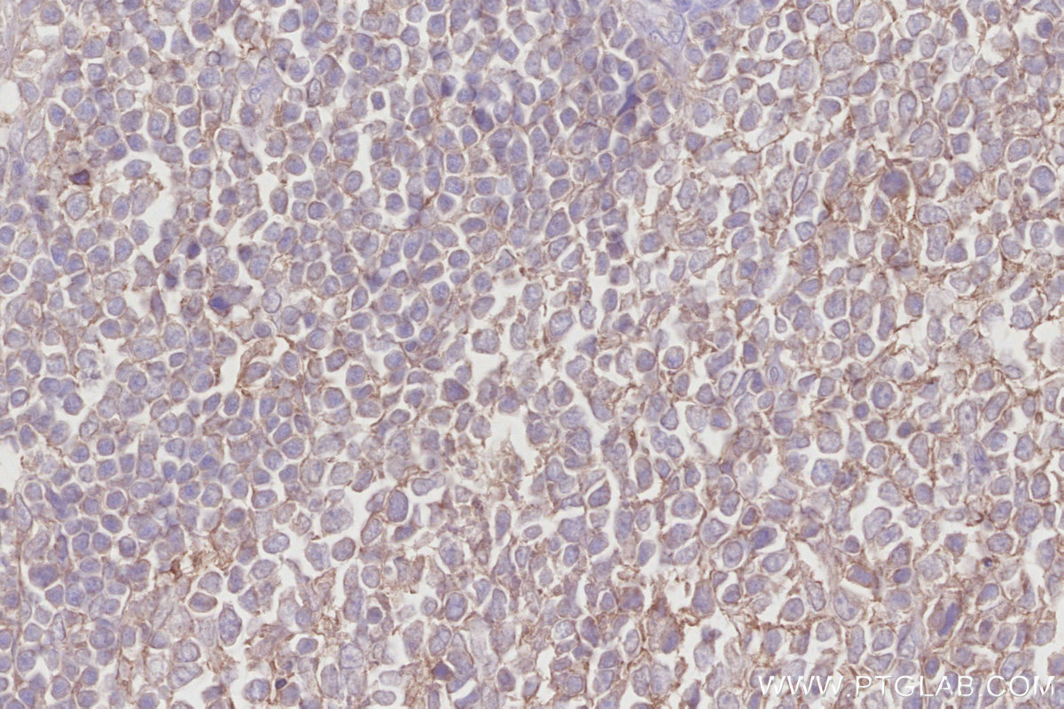 IHC staining of human appendicitis using 67228-1-Ig IHC staining of human appendicitis using 67228-1-Ig
