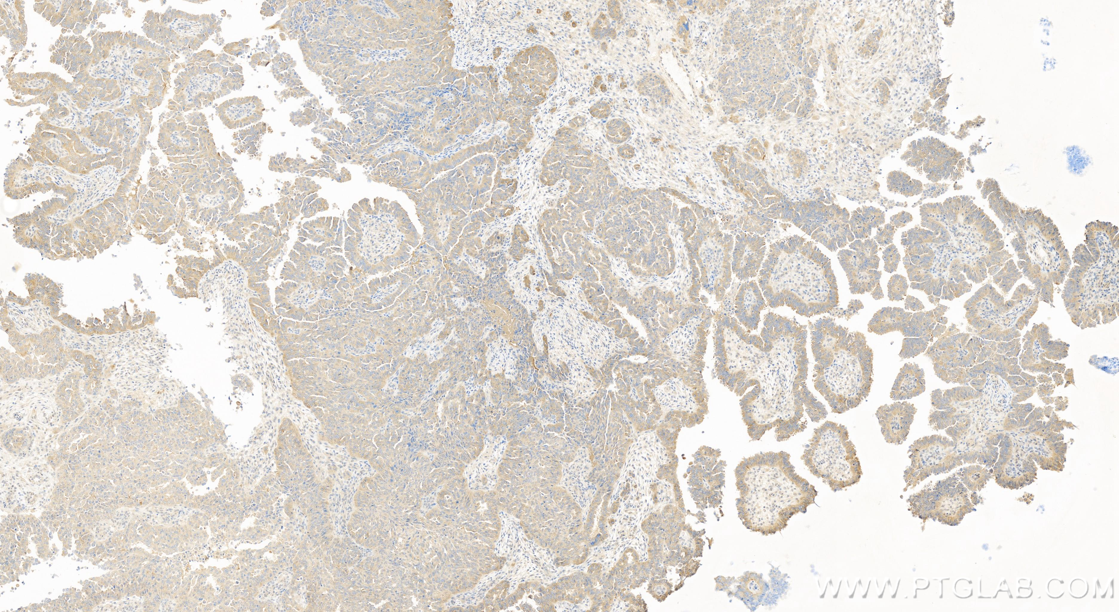 IHC staining of human ovary cancer using 84204-5-RR (same clone as 84204-5-PBS)