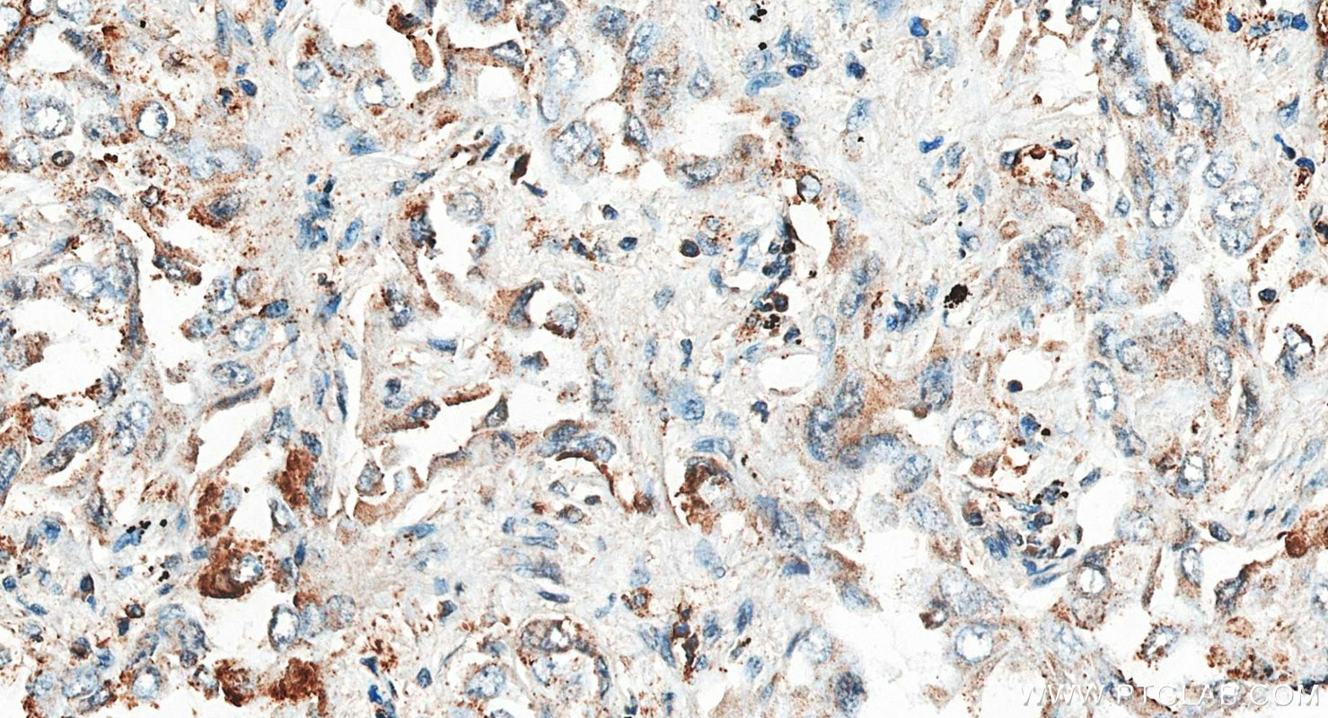 IHC staining of human lung cancer using 18138-1-AP