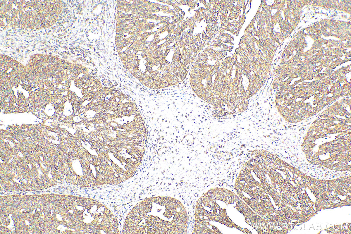 IHC staining of human ovary cancer using 18179-1-AP