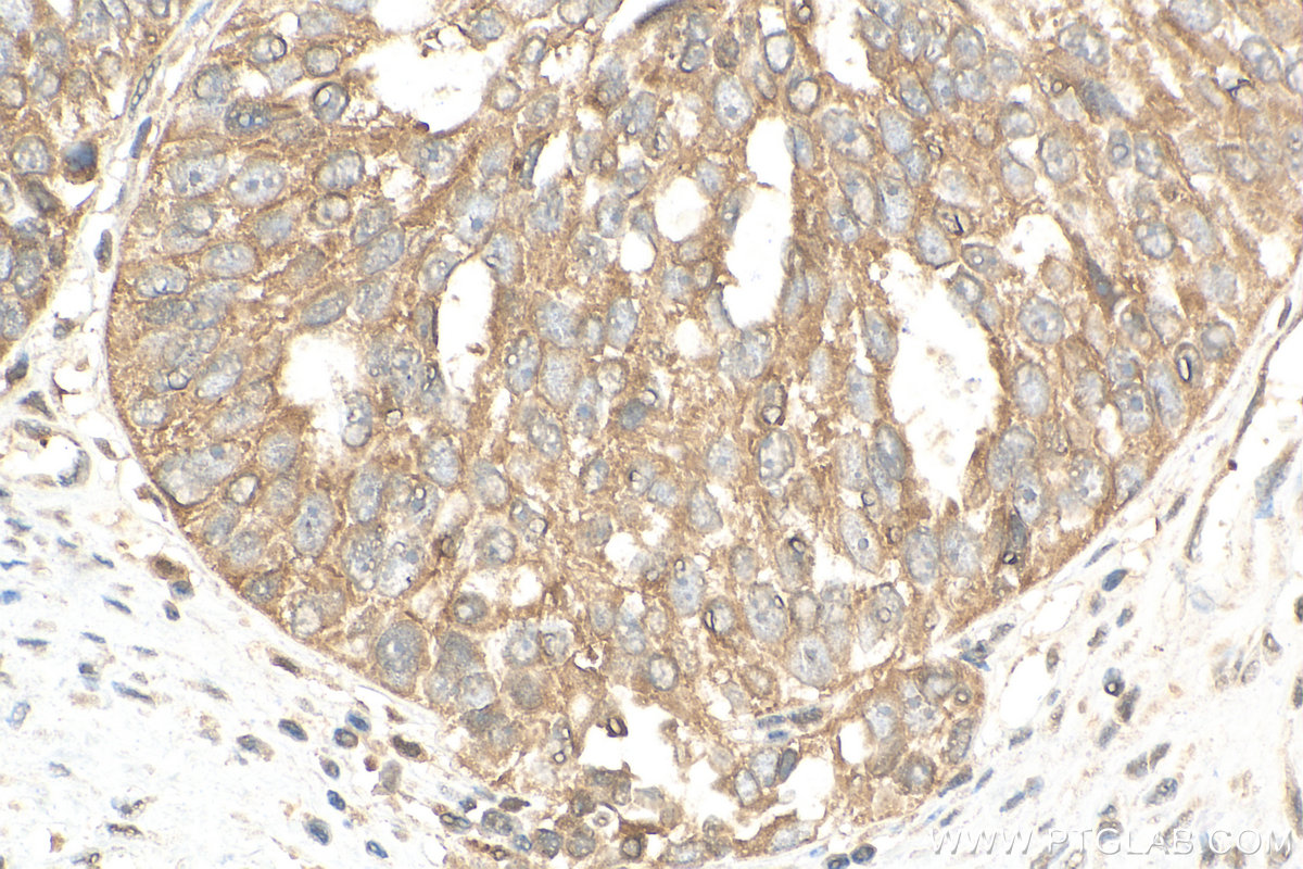 IHC staining of human ovary cancer using 18179-1-AP
