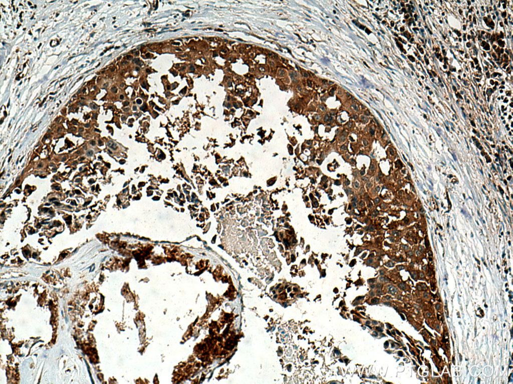 IHC staining of human breast cancer using 28548-1-AP