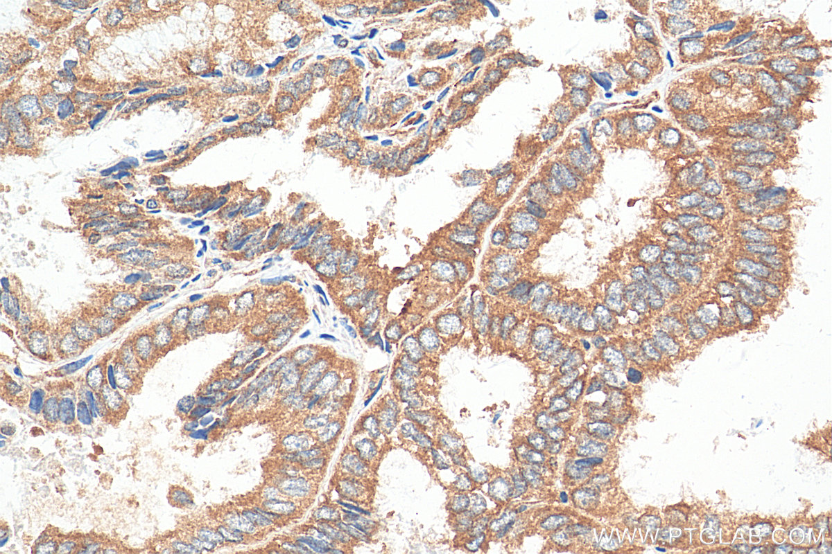 IHC staining of human ovary tumor using 28548-1-AP