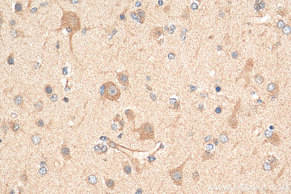 IHC staining of human gliomas using 28548-1-AP