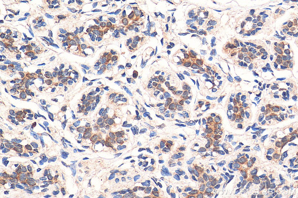 IHC staining of human breast cancer using 67960-1-Ig