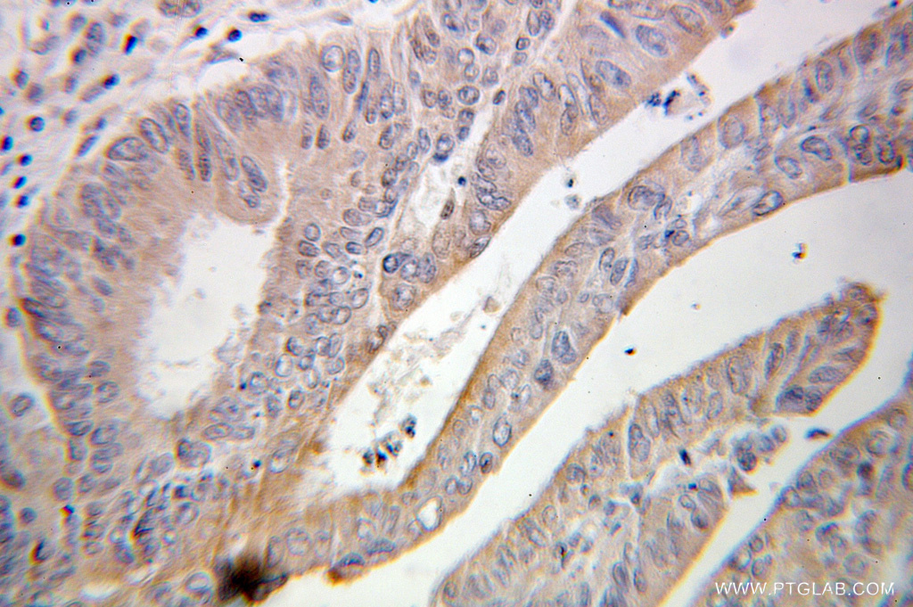 IHC staining of human colon cancer using 10226-1-AP