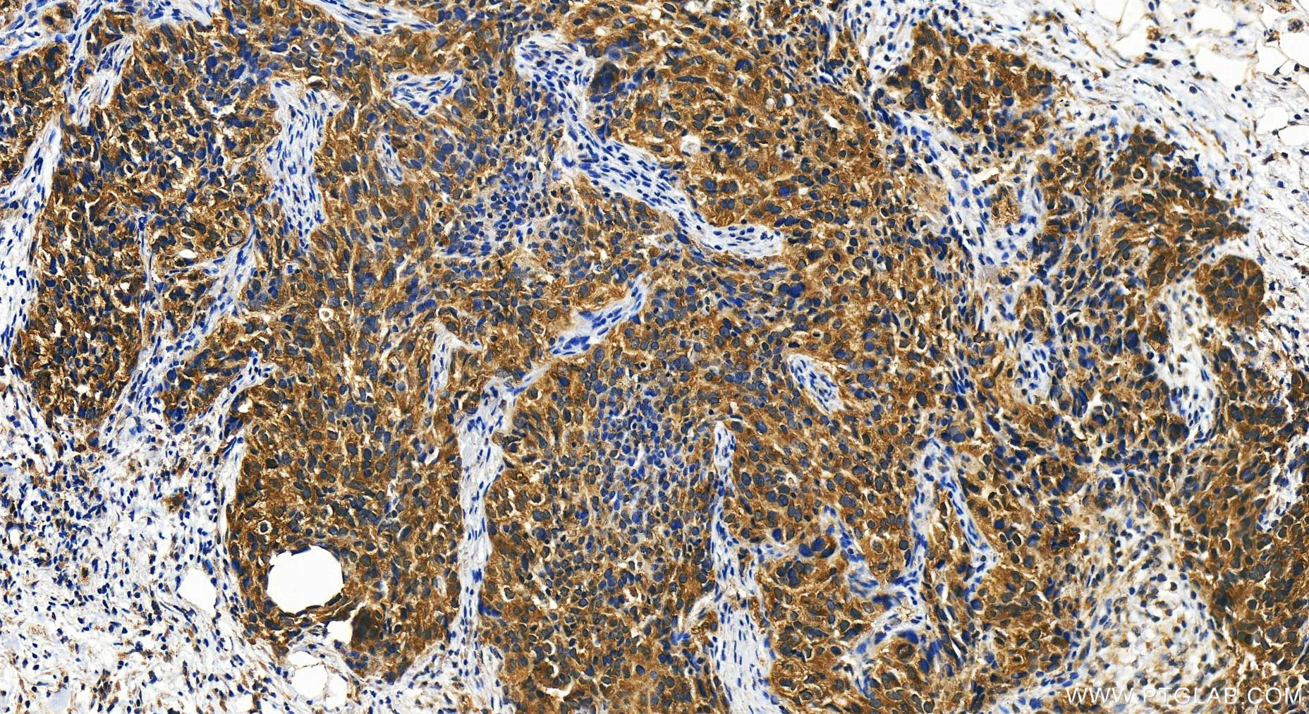 IHC staining of human ovary cancer using 15984-1-AP
