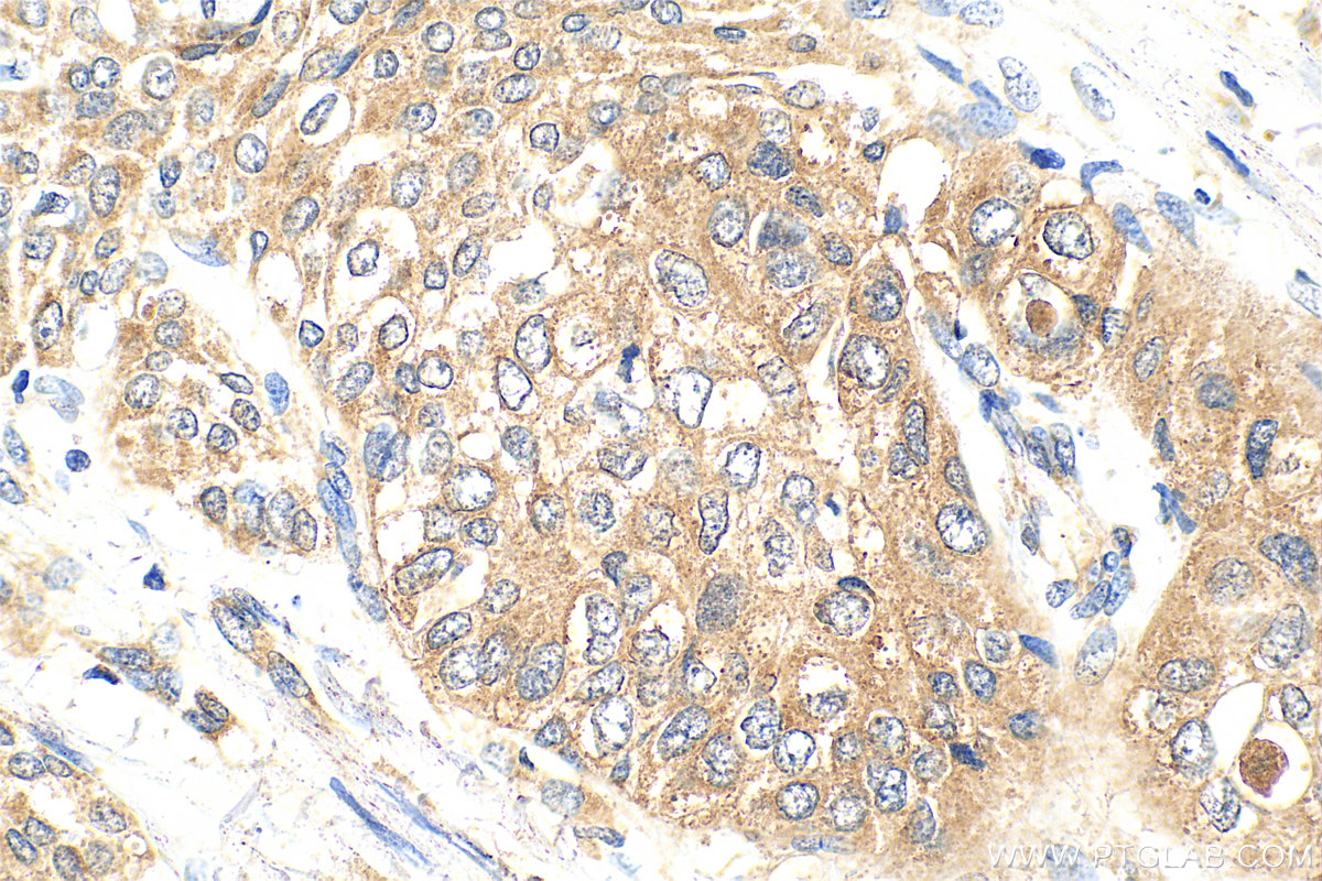 Immunohistochemical analysis of paraffin-embedded human urothelial carcinoma tissue slide using 32036-1-AP (ABHD4 antibody) at dilution of 1:200 (under 40x lens). Heat mediated antigen retrieval with Tris-EDTA buffer (pH 9.0). IHC staining of human urothelial carcinoma using 32036-1-AP