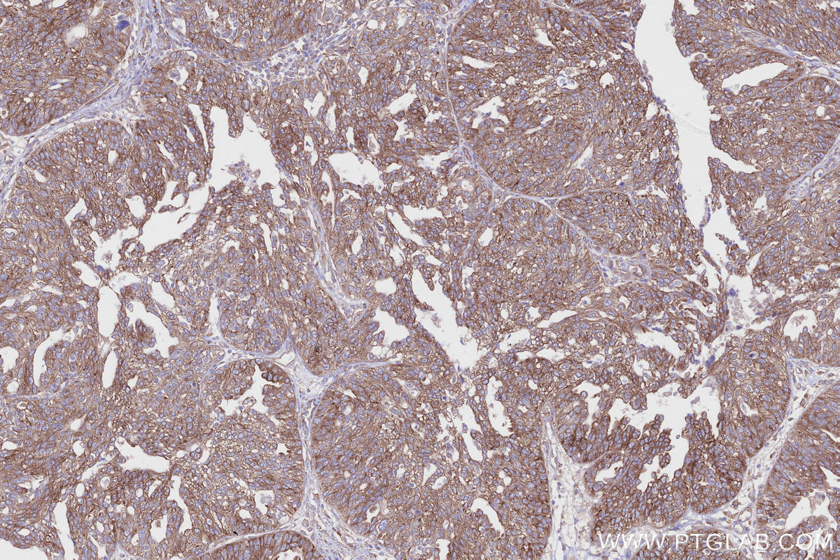 IHC staining of human ovary cancer using 27387-1-AP