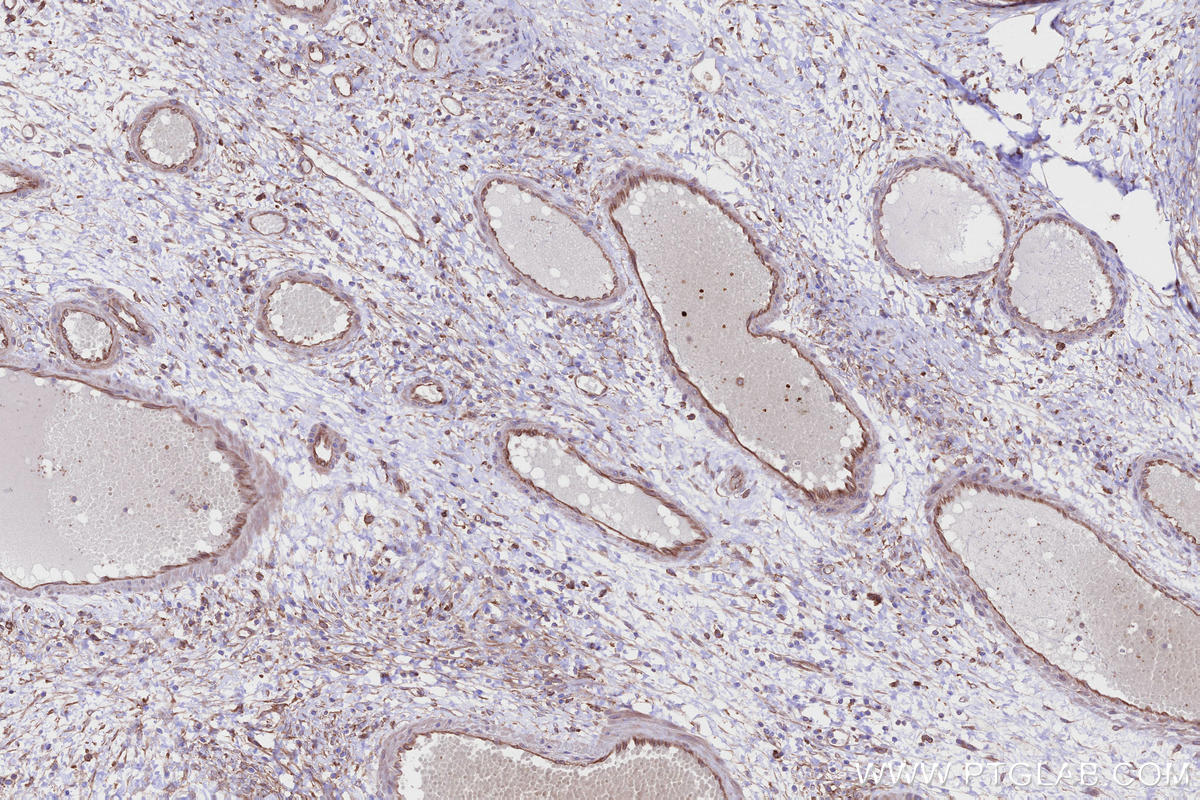 IHC staining of human ovary cancer using 27387-1-AP
