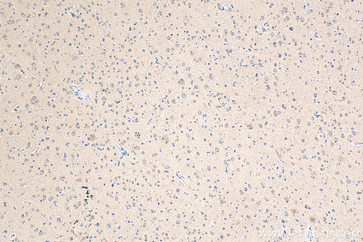 IHC staining of human gliomas using 17693-1-AP