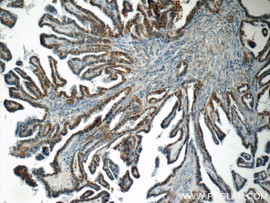 IHC staining of human thyroid cancer using 12319-2-AP