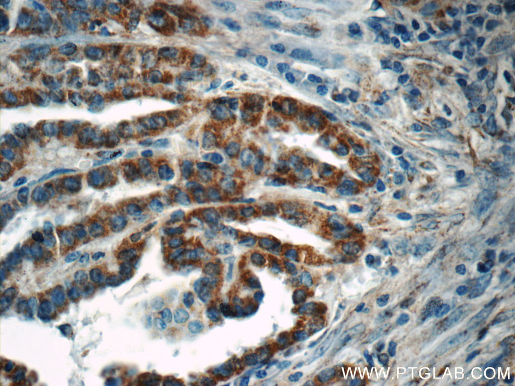 IHC staining of human thyroid cancer using 12319-2-AP