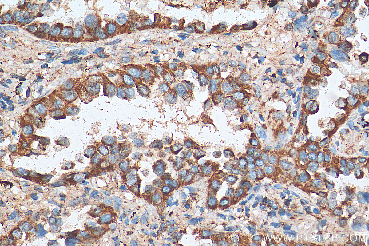 IHC staining of human lung cancer using 11111-1-AP