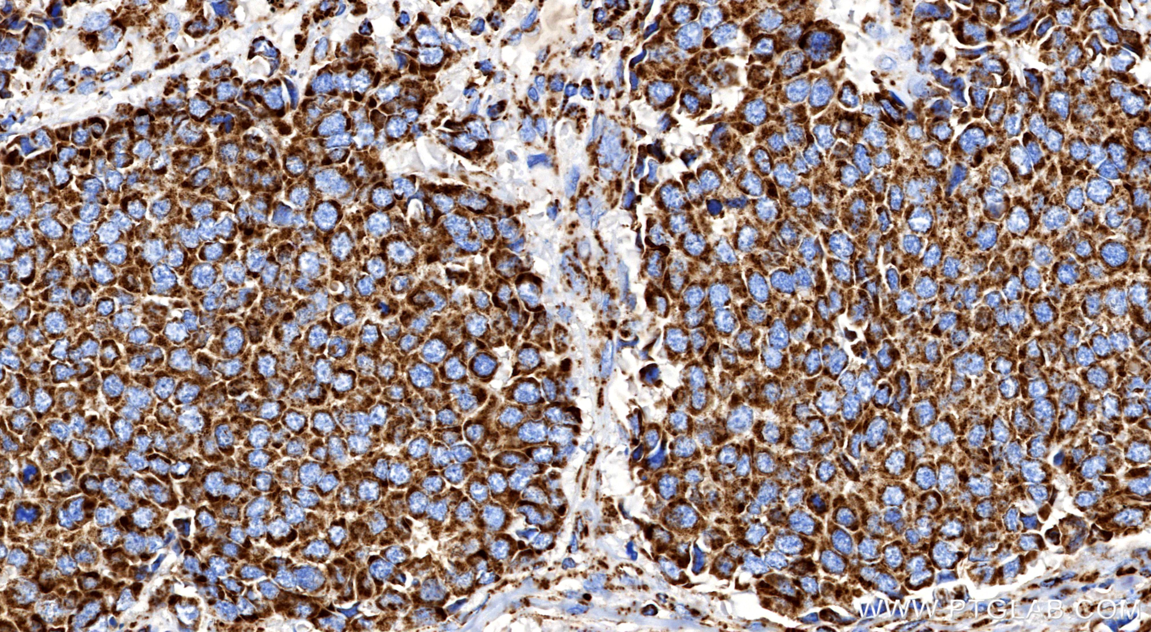 IHC staining of Human Small Cell Lung Cancer using 86161-3-RR