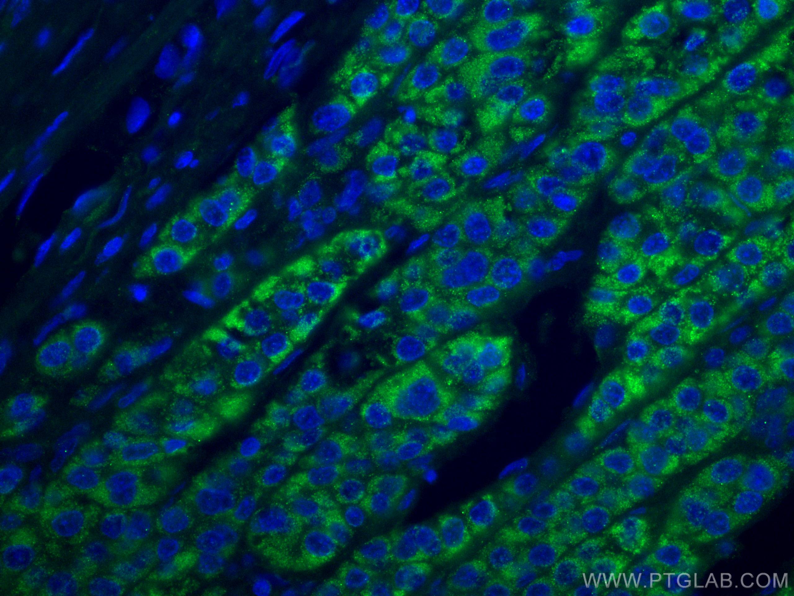 IF Staining of human liver cancer using 67742-1-Ig