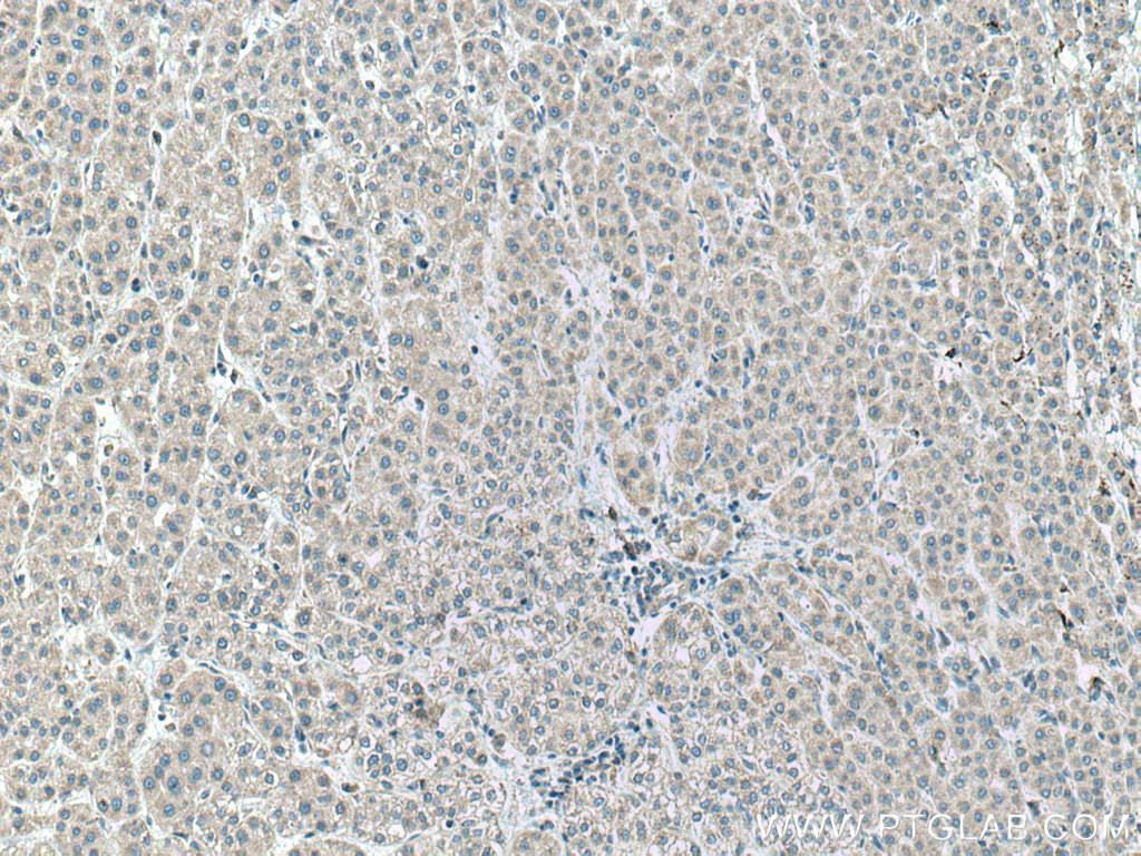 IHC staining of human liver cancer using 14527-1-AP