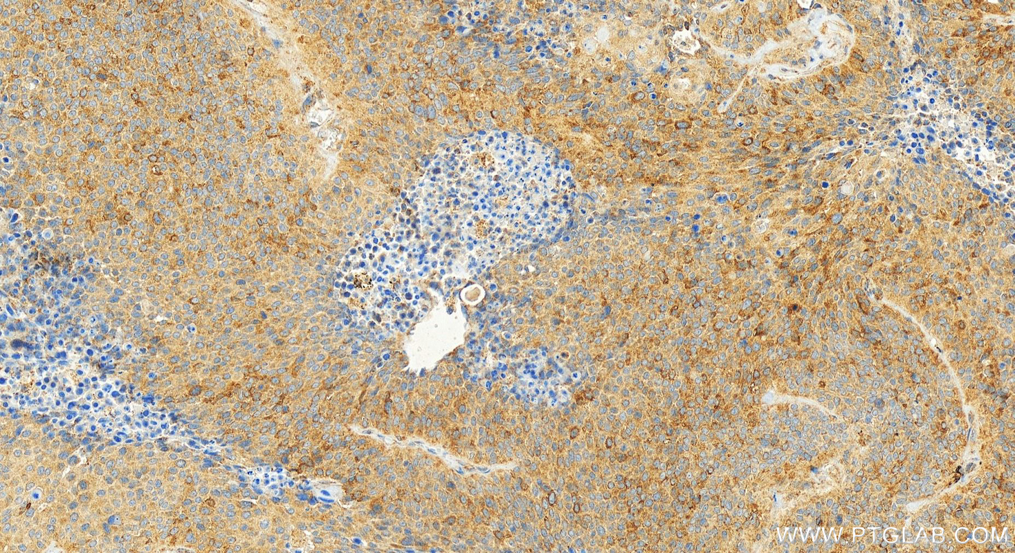 Immunohistochemical analysis of paraffin-embedded human lung squamous cell cancer slide using 20135-1-AP (ACAP1 antibody) at dilution of 1:400 (under 20x lens). Heat mediated antigen retrieval with Tris-EDTA buffer (pH 9.0). IHC staining of human lung squamous cell cancer using 20135-1-AP