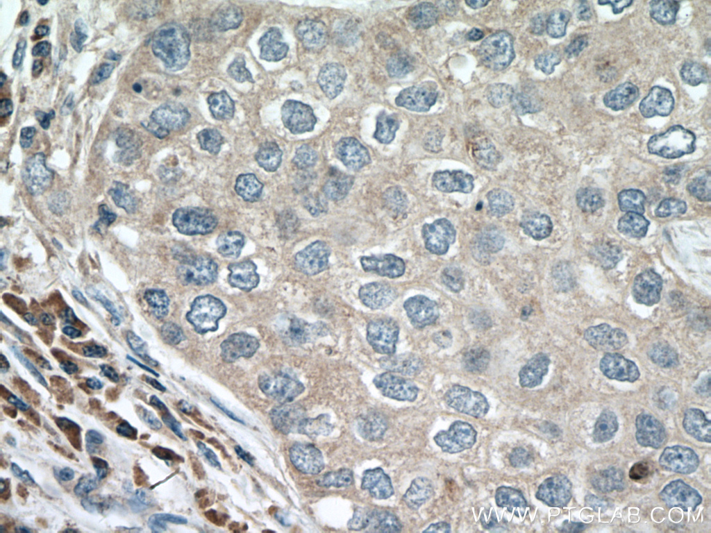 IHC staining of human breast cancer using 66596-1-Ig (same clone as 66596-1-PBS)