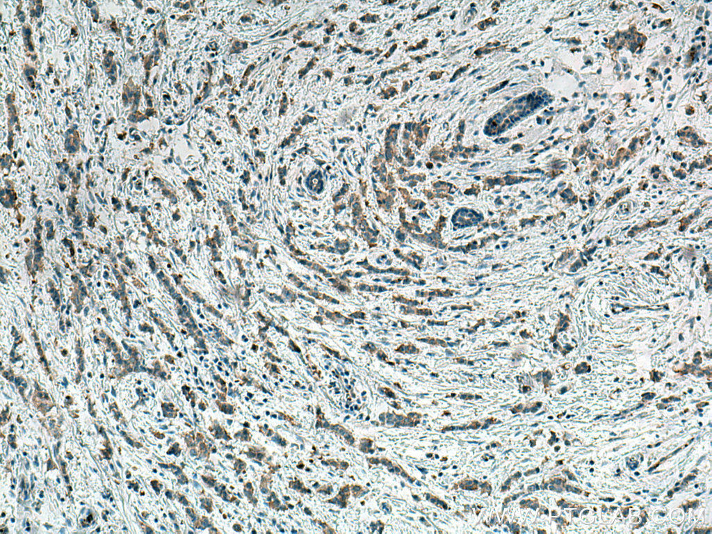 IHC staining of human breast cancer using 67373-1-Ig