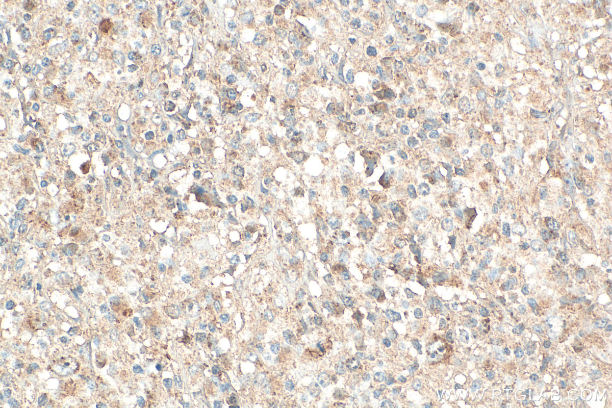 IHC staining of human lymphoma using 11491-1-AP