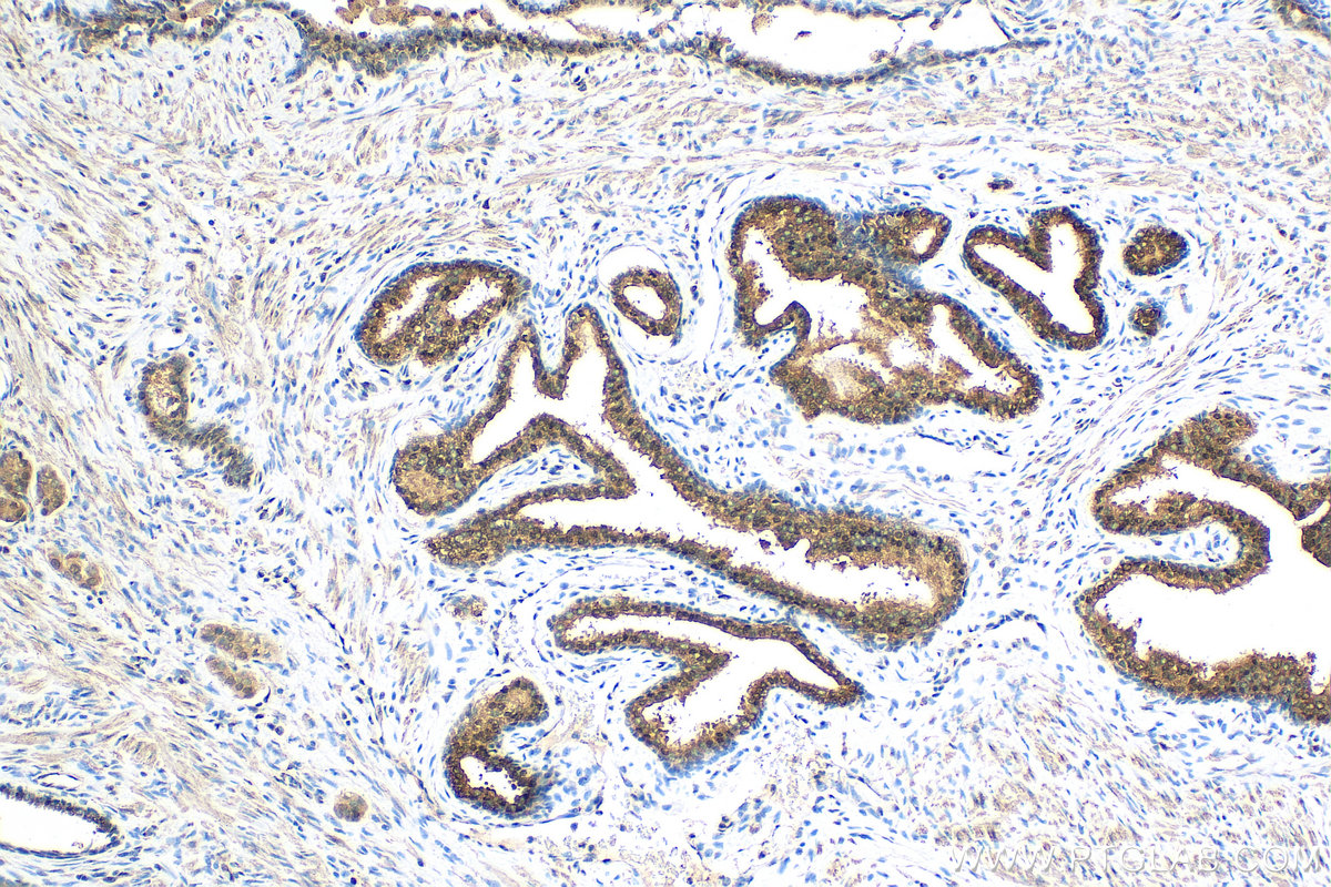 IHC staining of human prostate cancer using 15421-1-AP