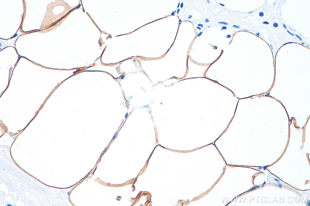 IHC staining of human prostate cancer using 67166-1-Ig