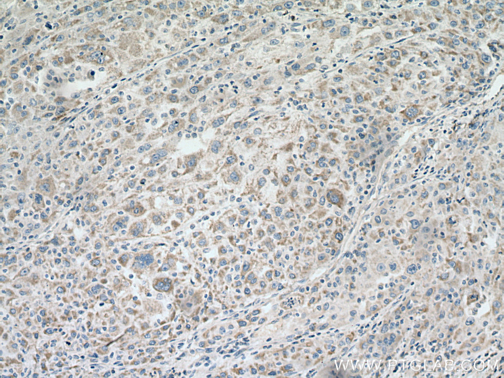 IHC staining of human liver cancer using 67509-1-Ig (same clone as 67509-1-PBS)