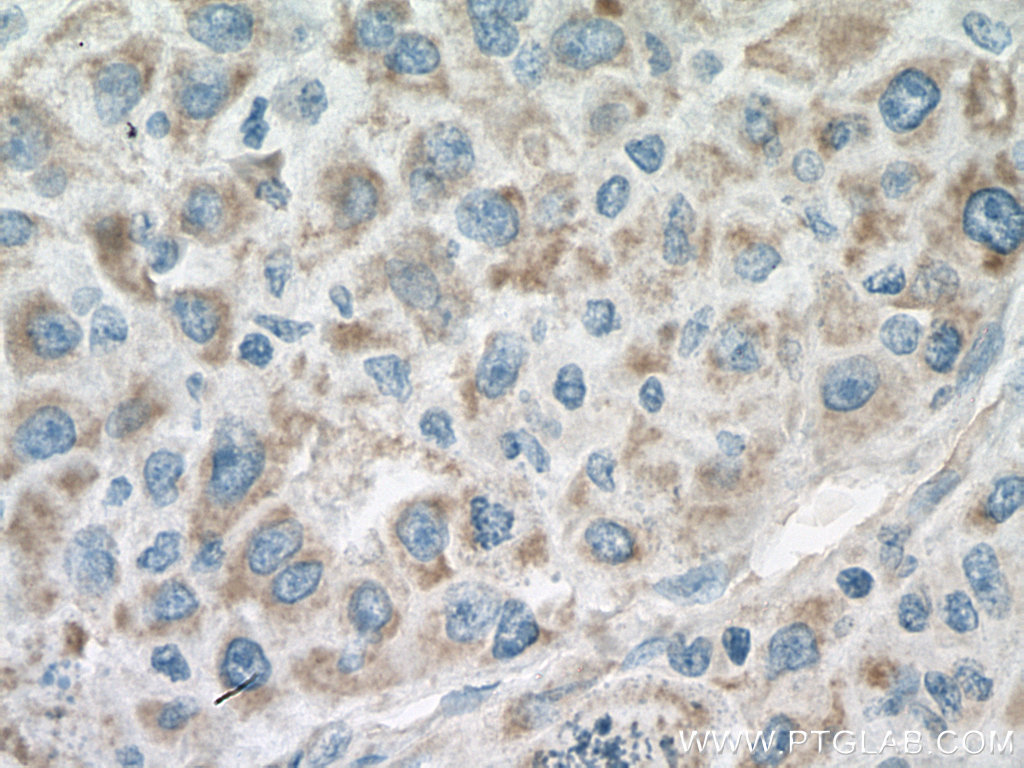 IHC staining of human liver cancer using 67509-1-Ig (same clone as 67509-1-PBS)