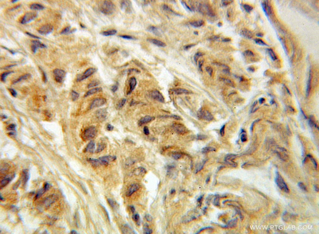 IHC staining of human prostate cancer using 10776-1-AP