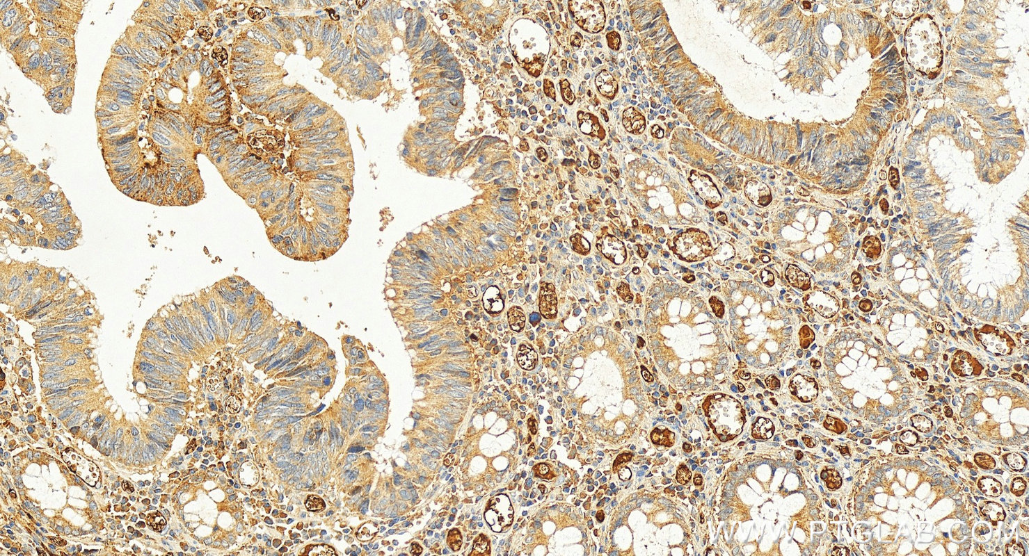 IHC staining of human colon cancer using 17871-1-AP