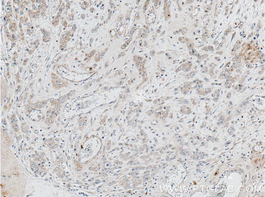 IHC staining of human colon cancer using 66532-1-Ig