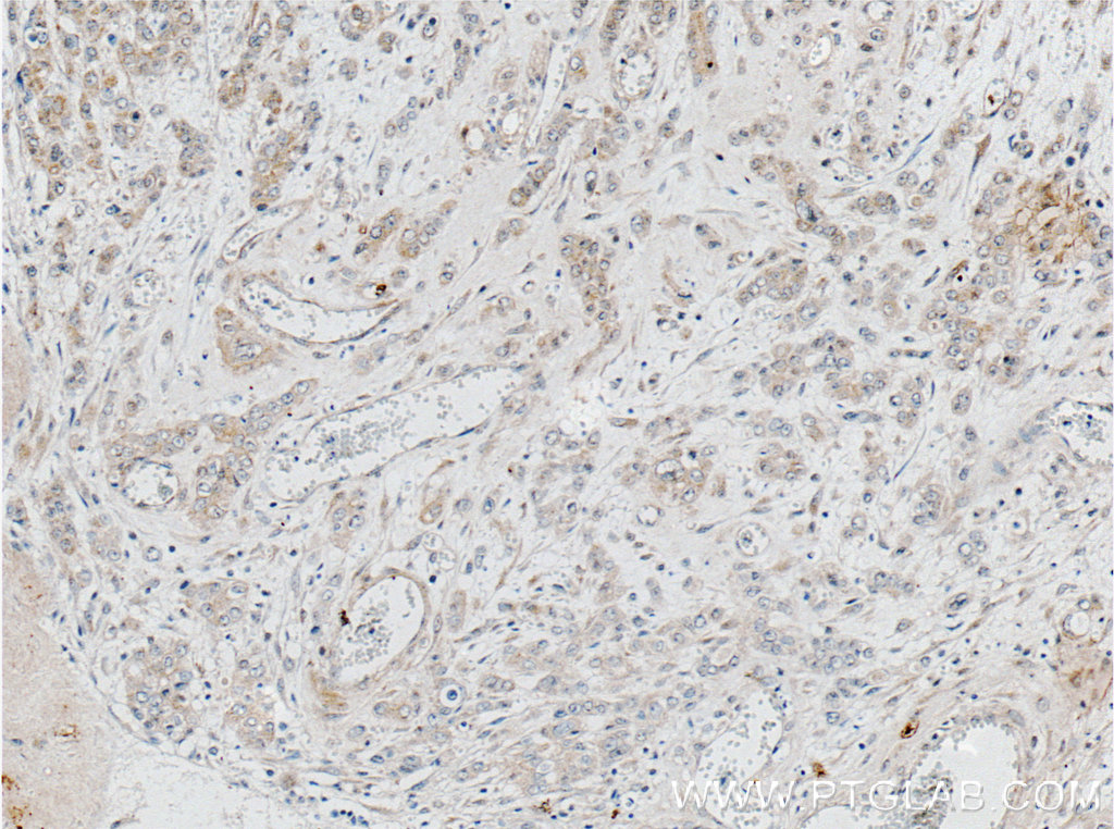 IHC staining of human colon cancer using 66532-1-Ig (same clone as 66532-1-PBS)