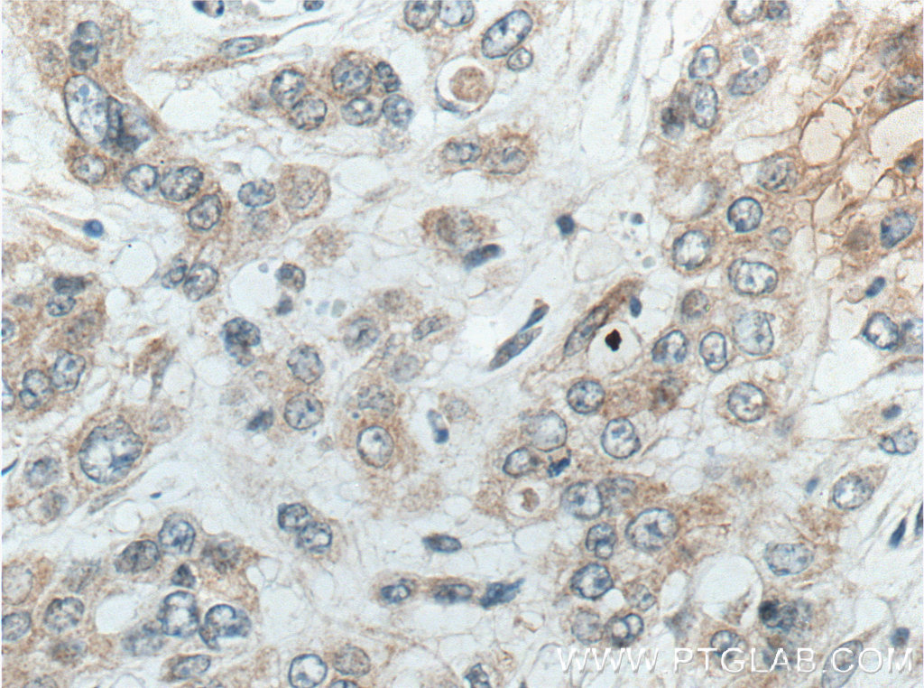 IHC staining of human colon cancer using 66532-1-Ig