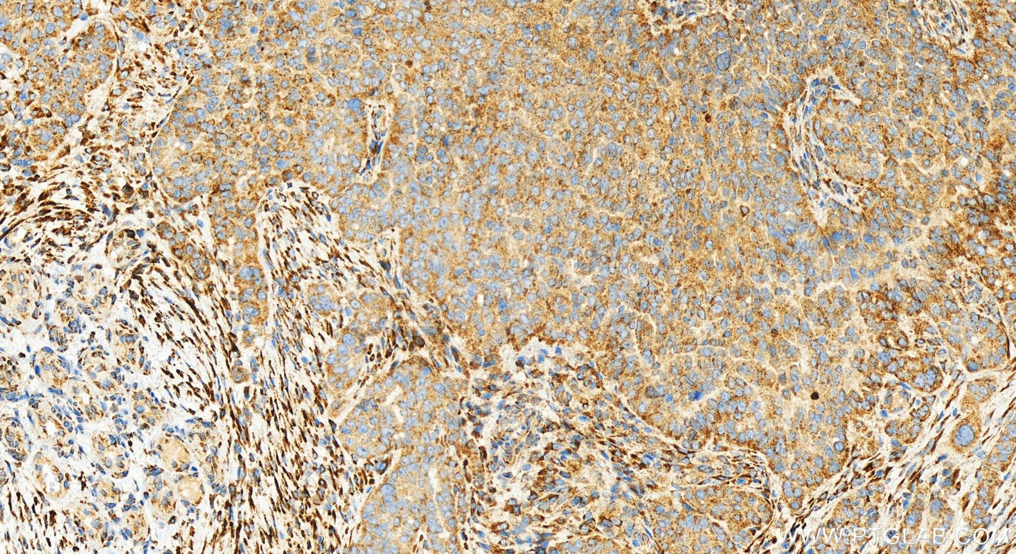 IHC staining of human ovarian  cancer using 83731-2-RR (same clone as 83731-2-PBS)