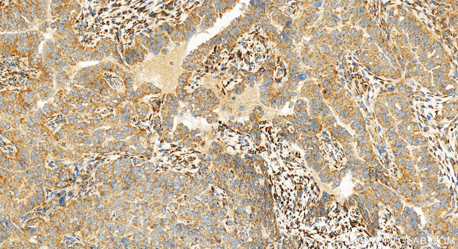 IHC staining of human ovarian  cancer using 83731-2-RR (same clone as 83731-2-PBS)