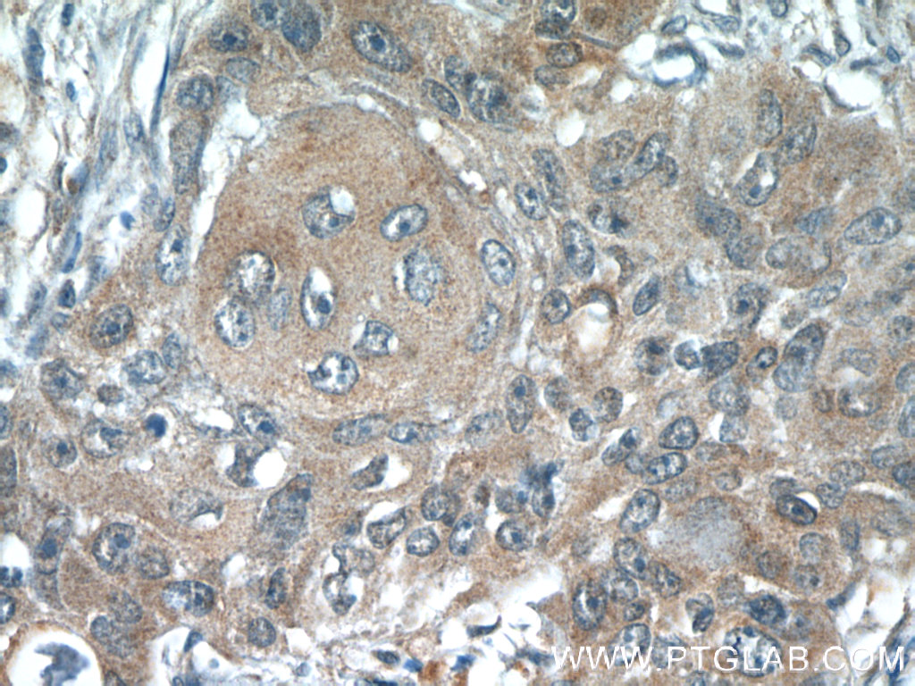 IHC staining of human lung cancer using 22214-1-AP