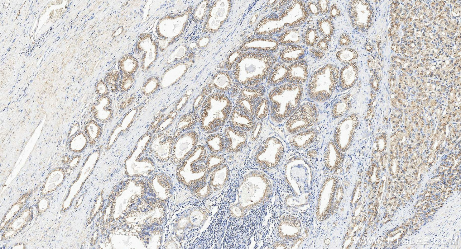 IHC staining of human prostate cancer using 12965-1-AP IHC staining of human prostate cancer using 12965-1-AP
