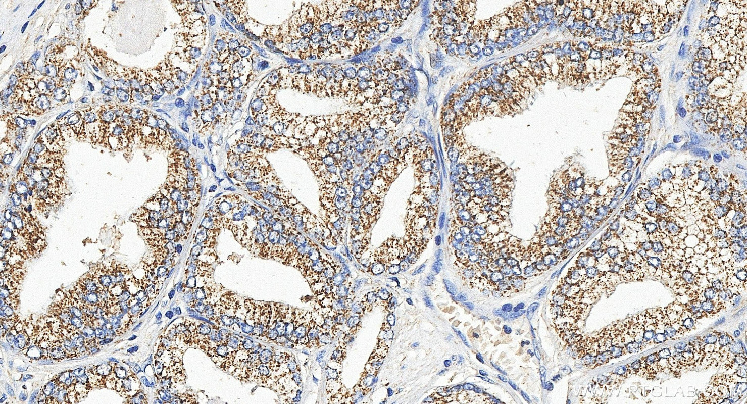 IHC staining of human prostate cancer using 12965-1-AP IHC staining of human prostate cancer using 12965-1-AP