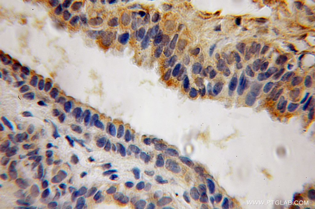 IHC staining of human prostate cancer using 12965-1-AP