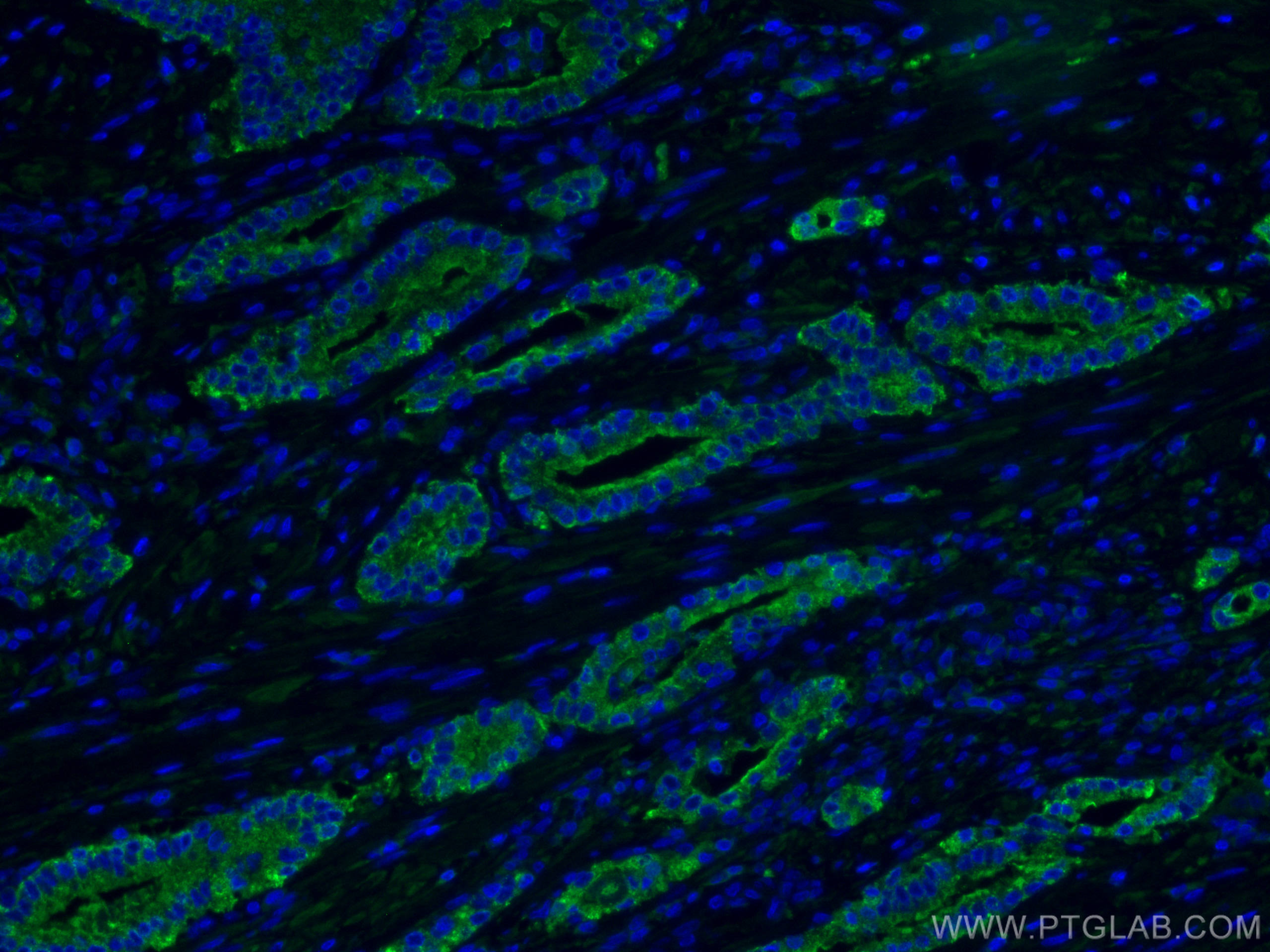 IF Staining of human prostate cancer using 60176-1-Ig