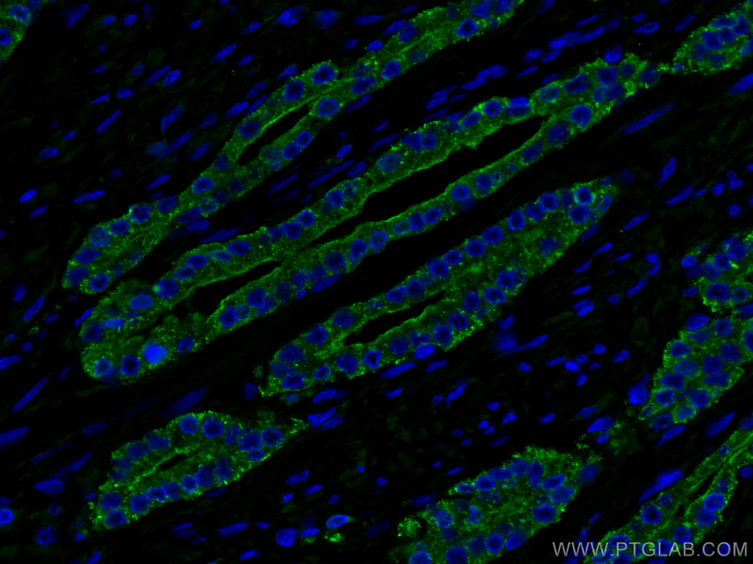 IF Staining of human prostate cancer using 60176-1-Ig