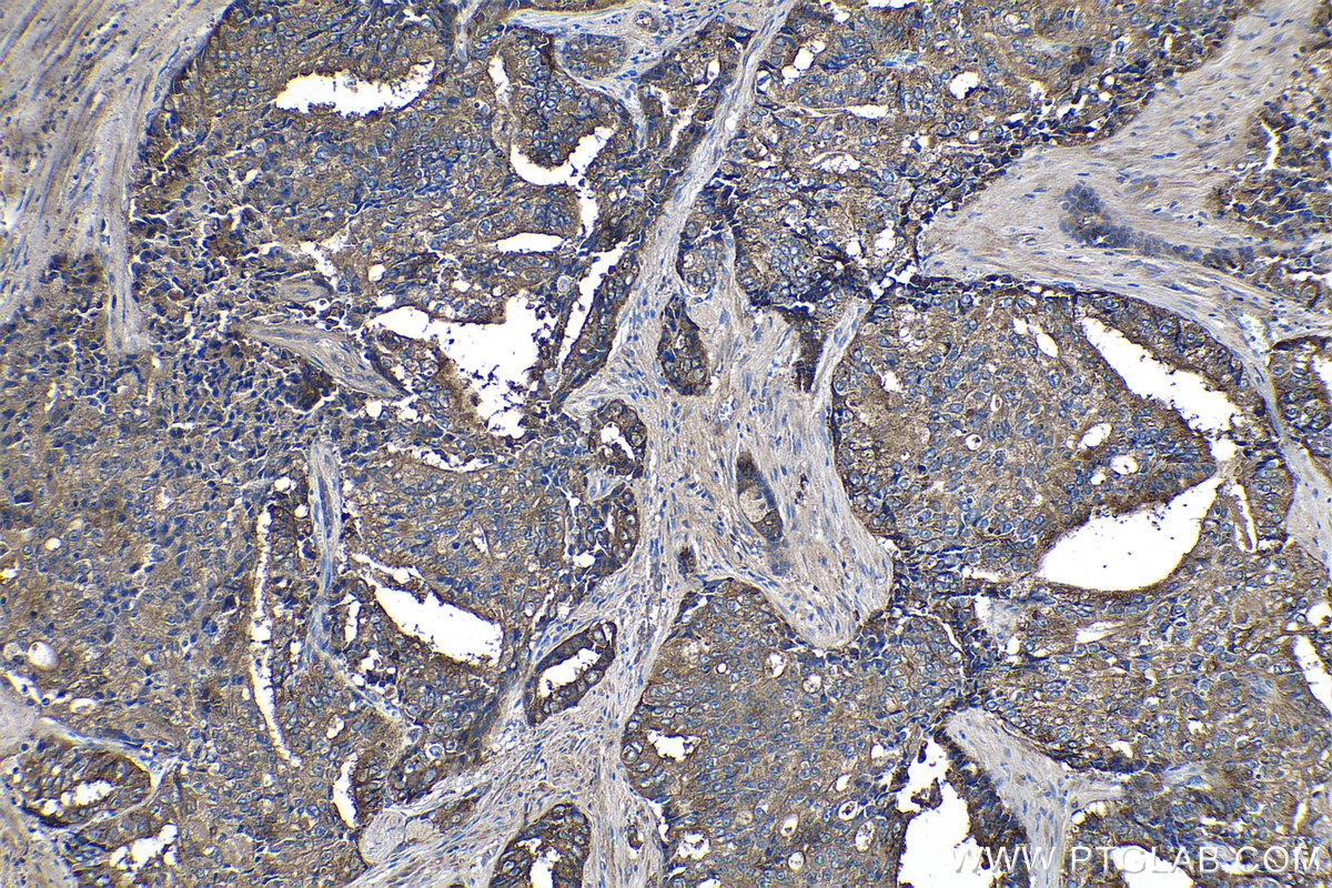 IHC staining of human prostate hyperplasia using 60176-1-Ig (same clone as 60176-1-PBS)