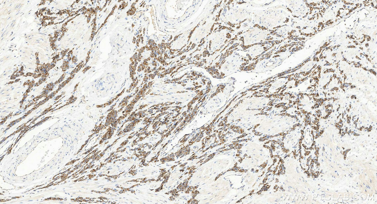 IHC staining of human prostate cancer using Biotin-60176