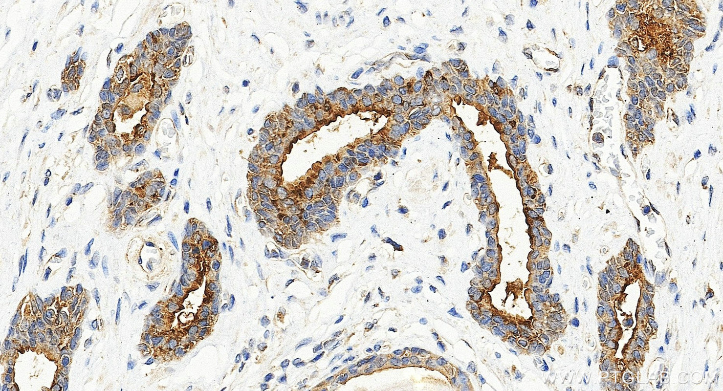 IHC staining of human prostate cancer using Biotin-60176