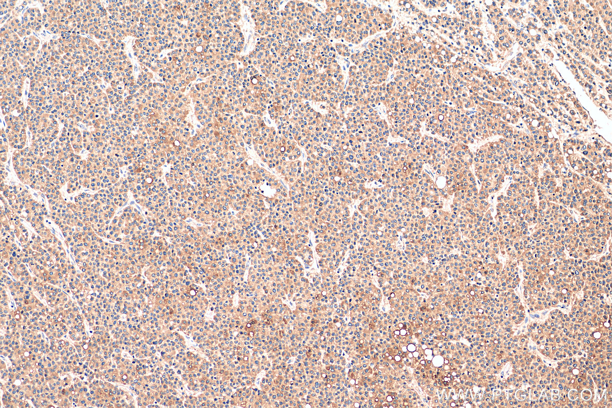 IHC staining of human liver cancer using 81196-1-RR